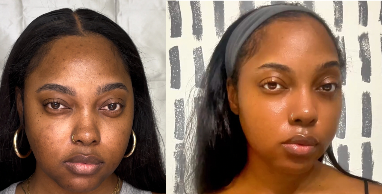 Morgan Ashley melanin-rich skin before and after hyperpigmentation treatment &mdash; dark skin over 40